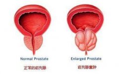 天水前列腺囊肿原因有哪些?