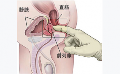 天水前列腺钙化灶影响生育吗?