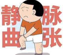 天水静脉曲张的发病原因有哪些?