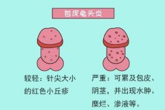念珠菌性龟头炎会疼吗?